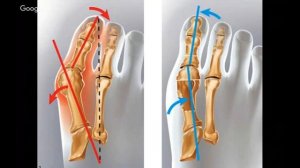 Почему болит стопа? Деформация стопы.