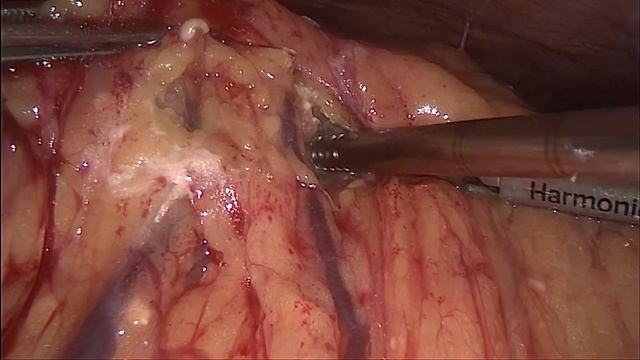 , #pancreonecrosis, #surgery, #laparoscopic, #панкреонекроз смотреть онлайн