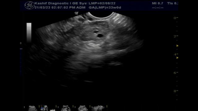 PCOS Polycystic Ovaries | Grading Mild | Polycystic Ovarian Syndrome | PCOD | Ultrasound смотреть онлайн