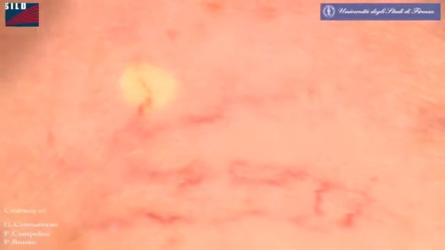 Vascular Treatment With DEKA Nd YAG Laser