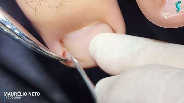 A NAMORADA BEM QUE TENTOU AJUDAR MAS NÃO DEU CERTO #podologomaurelio #ingrowntoenail смотреть онлайн