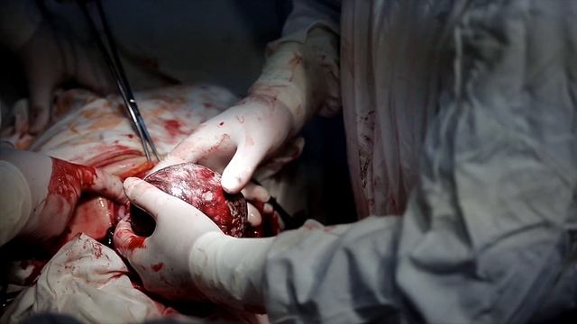 What to expect during a C-section | Real Footage смотреть онлайн
