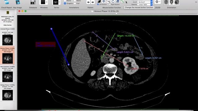 How to use Osirix/ Horos - part 1 смотреть онлайн