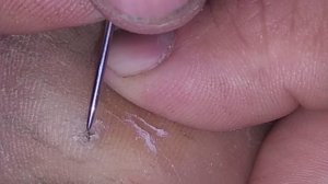 операция по извлечению занозы