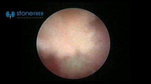 Дробление камней в почка. Удаление камня почки лазером в Москве. Миниперкутанная нефролитотрипсия.