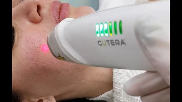 Лазерное лечение акне и постакне Cutera Laser Genesis смотреть онлайн