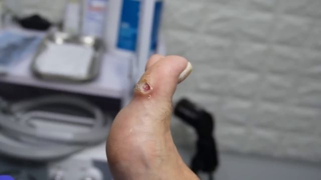 Infected Blister POPS During Treatment