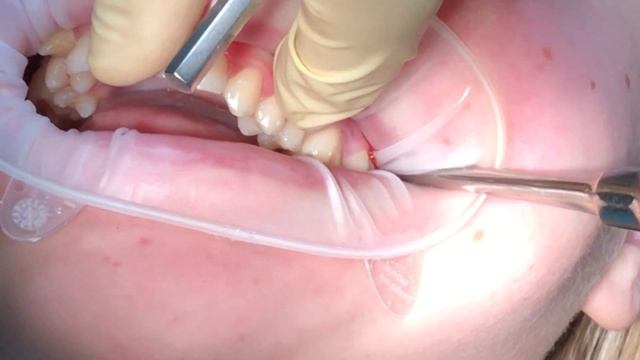 Удаление зуба мудрости / (Выпуск 7) смотреть онлайн