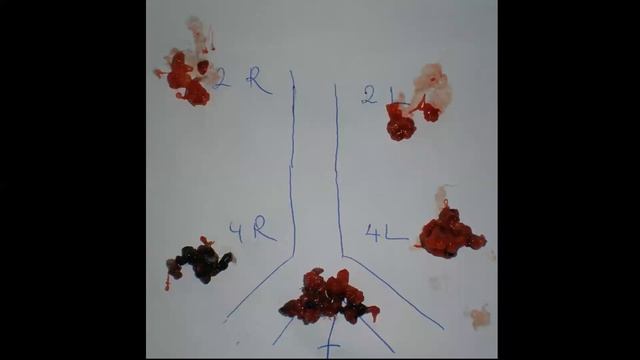 Mediastinal staging смотреть онлайн