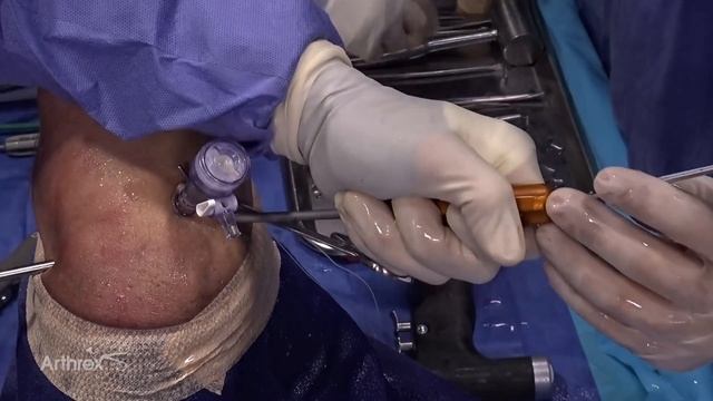 Knotless Double-Row Subscapularis Repair With Biceps Tenodesis смотреть онлайн