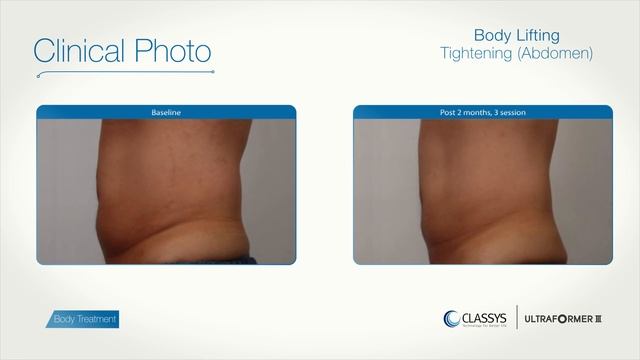 ULTRAFORMER HIFU UltrasoundㅣSkin Tightening Body Treatments | Abdomen, Axillar, Thighs
