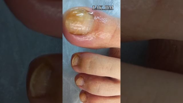 ГРИБОК НОГТЕЙ ?Места заражения? Кто в риске? Что с этим делать? Кто лечит?? смотреть онлайн