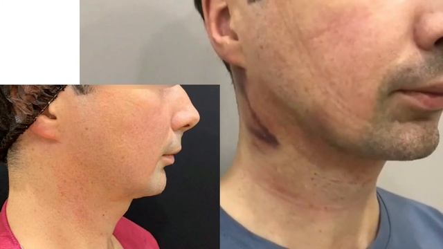 ДВОЙНОЙ ПОДБОРОДОК смотреть онлайн