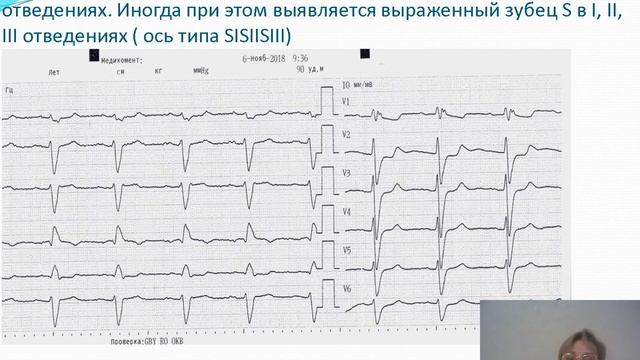 ЭКГ. Гипертрофия отделов сердца. Павлова Н. П. смотреть онлайн
