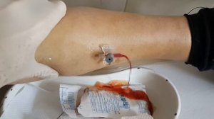 разрыв кисты Беккера