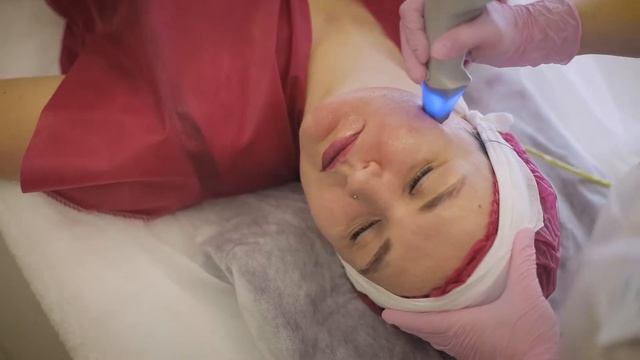 RF-лифтинг (радиочастотный лифтинг) лица