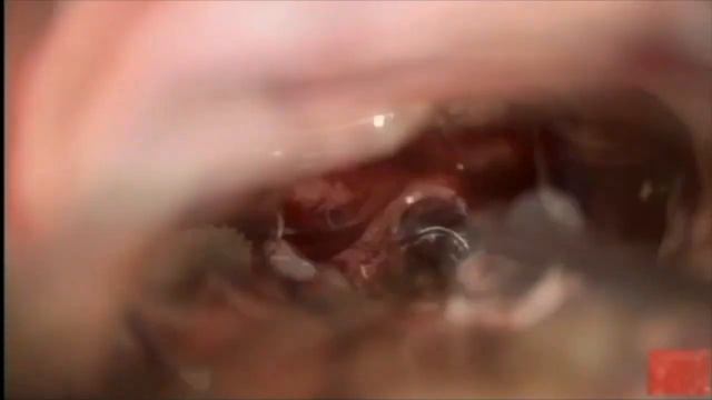 Microsurgical Resection of Thalamic Grade IV Astrocytoma смотреть онлайн