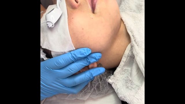 Peel Season ClarityRX Aha Lactic Acid Peel￼