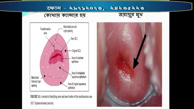 SUSWASTHA : সারভ্যাইক্যাল ক্যান্সার-প্রতিরোধ ও প্রতিকার смотреть онлайн