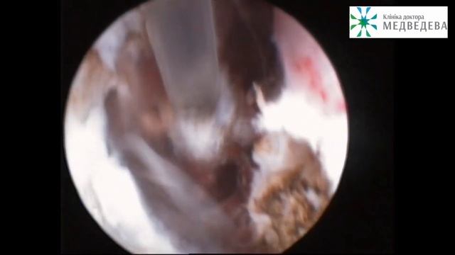 Полип эндометрия, удаление лазером, офисная гистероскопия смотреть онлайн