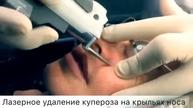 Лазерное удаление купероза Косметология СПб Дк Форма смотреть онлайн