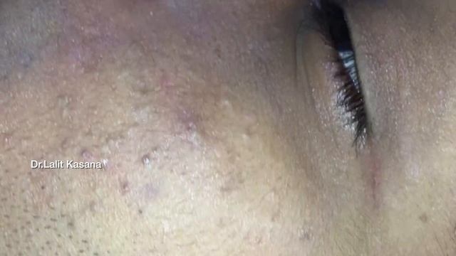 BIG BLACKHEAD REMOVAL Part- 1 смотреть онлайн