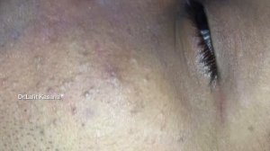 BIG BLACKHEAD REMOVAL Part- 1