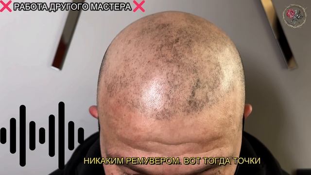 Исправление работы другого мастера. Трихопигментация лучше пересадки Botched Scalp Micropigmentatio смотреть онлайн