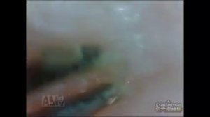 Выдавливание черных точек на носу/Squeezing blackheads