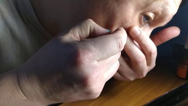 Удалить жировик на лице. Дома.