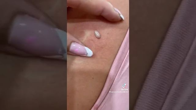 Popping Huge Blackheads And Pimple Popping - Best Pimple Popping Videos #2