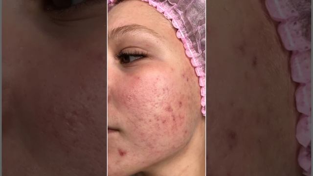 Лазерная шлифовка лица в Санкт-Петербурге смотреть онлайн