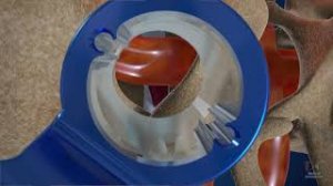 Микродискэктомия - удаление грыжи диска позвоночника.