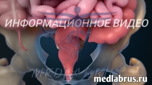 Удаление прямой кишки