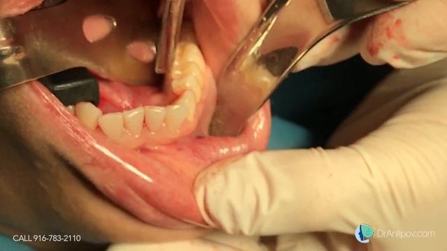 Mandibular Tori (surgery)(Removal) смотреть онлайн