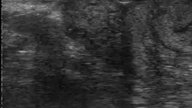 Фолликулярная киста смотреть онлайн