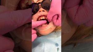 ? Установка ортодонтической пластинки на зубы у детей