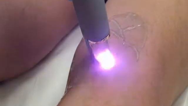 Varicose Veins Treatment Montreal - Laser vascular therapy of face and leg spider veins смотреть онлайн