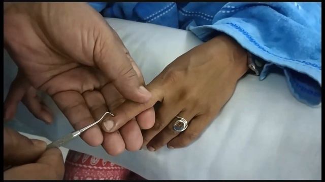 ACU 31: Jimmy Acupressure Technique at Acu Point LI-1 смотреть онлайн