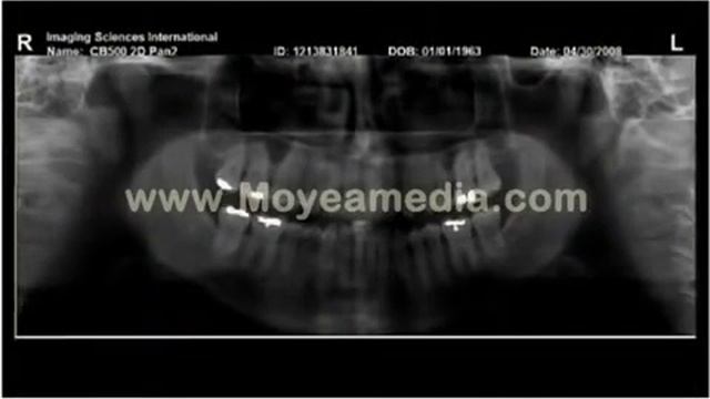 Cone Beam CT készítése Gendex GXCB 500 készülékkel смотреть онлайн
