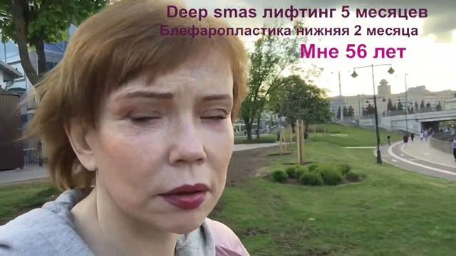 Deep Smas лифтинг 5 месяцев, блефаропластика 2 месяца