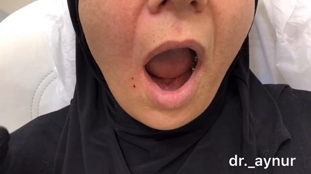 Agiz etrafi dolgu. Заполнение носогубных складок смотреть онлайн