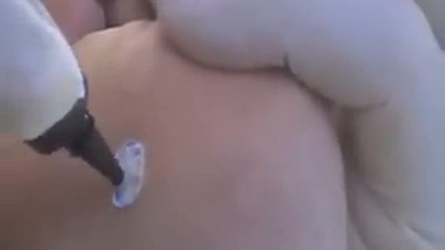 Криохирургический аппарат КриоПен (CryoPen) // ООО "Криотек" смотреть онлайн