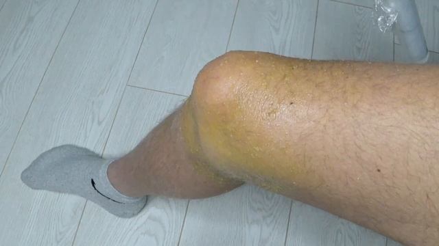 БОЛЬ В КОЛЕНЕ УЙДЁТ ЗА СЧИТАННЫЕ МИНУТЫ// Простое средство от АРТРОЗА смотреть онлайн