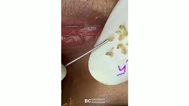 BEST PIMPLE POPPING COMPILATION 2022 || PART- 2