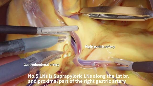 D2 lymph node dissection - using blender смотреть онлайн