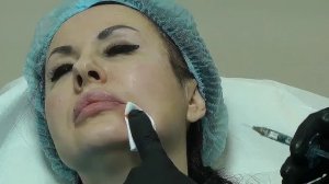 Коррекция филлерами зоны депрессии (морщины скорби).