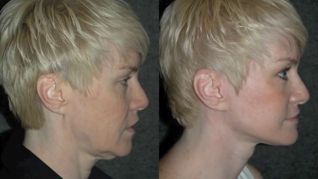 Mini Facelift By Dr Andrew Jacono #minifacelift