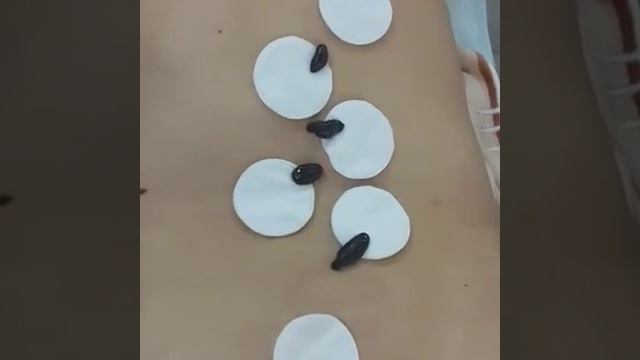 Хиджама лица, гирудотерапия. смотреть онлайн