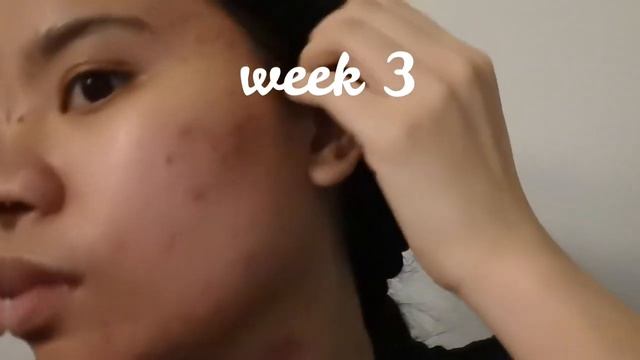COSRX | 1 MONTH REVIEW + RESULTS On ACNE SKIN | AHA BHA Clarifying Treatment Toner